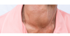 Goiter and Iodine Deficiency Disorders
