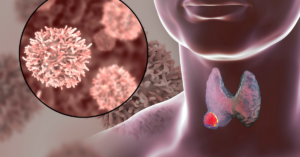 Thyroid Cancer